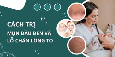 Ngăn ngừa mụn bằng cách se khít lỗ chân lông da mặt