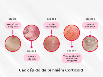 Nhận biết da bị nhiễm Corticoid và cách chăm sóc