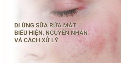 Dấu hiệu sữa rửa mặt không phù hợp với làn da