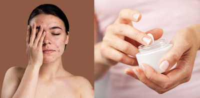 Sử dụng mỹ phẩm mùa hè có gây bí da hay không?