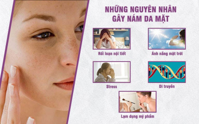 Da bị sạm nám: Nguyên nhân và cách điều trị hiệu quả