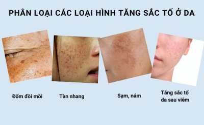 Hiểu rõ về sắc tố đen trên da và tác nhân gây ra