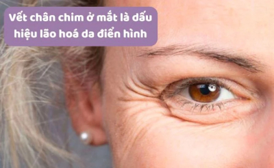 Làm mờ vết chân chim giảm thiểu lão hóa vùng quanh mắt